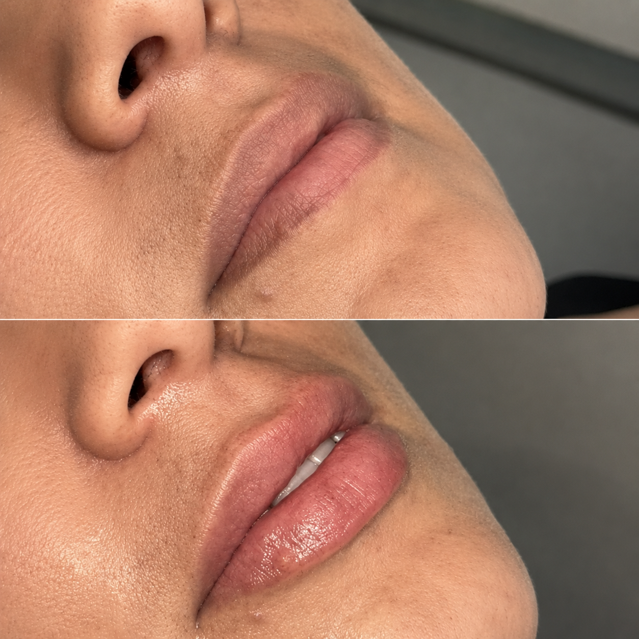 Preenchimento labial — Harmonização Facial — Dra. Olivia Brandão
